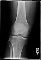 osteoarthritis and weight loss