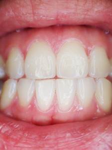 Ayurvedic gingivitis remedy