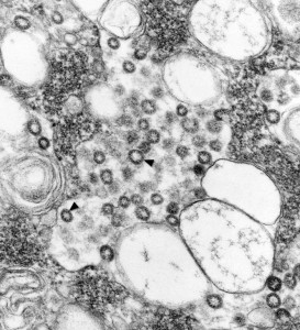 h. pylori H. pylori ulcers cancer