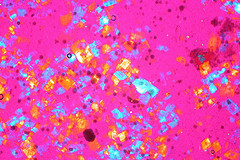 rheumatoid arthritis linked with intestinal bacteria