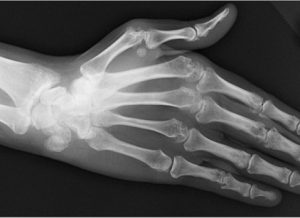 Tripterygium root for rheumatoid arthritis