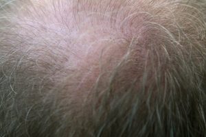natural remedies for losing hair