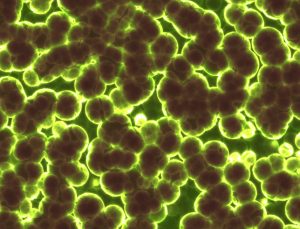 Spondyloarthritis produced by bad gut bacteria.